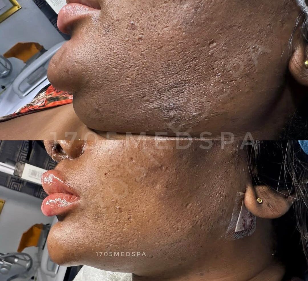 Chin Enhancement