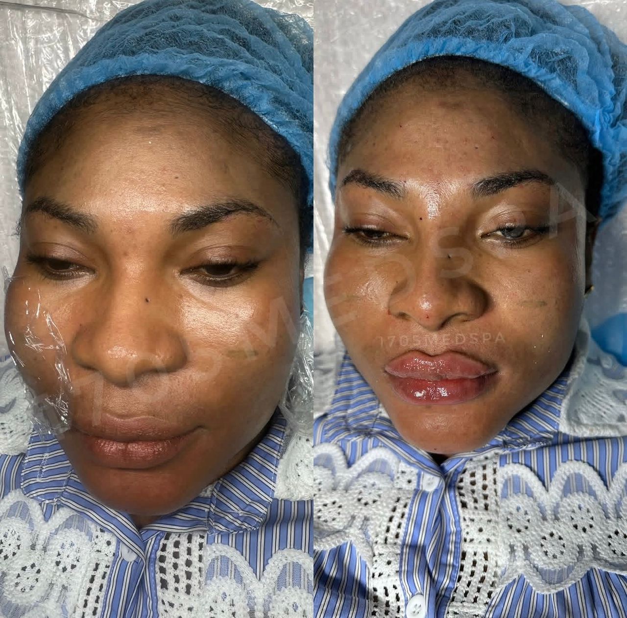 Body facial treatment